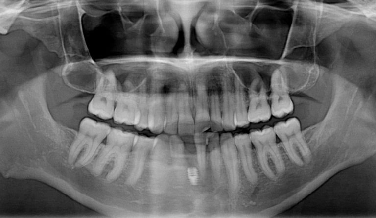 a x-ray of a human teeth