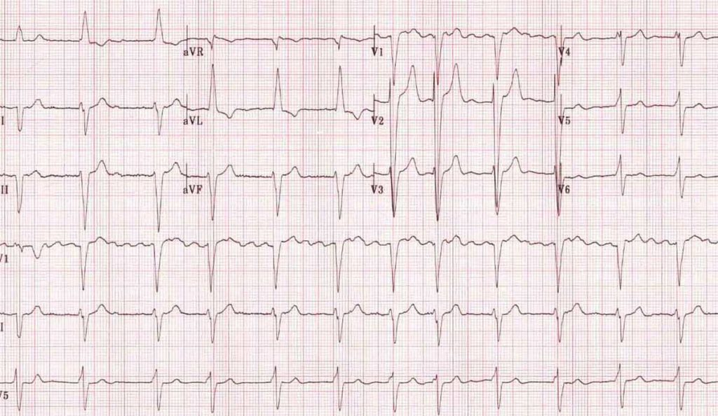 EKG showing atrial fibrillation