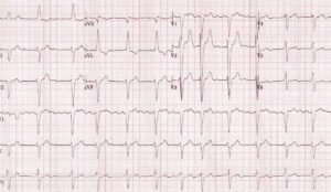 EKG showing atrial fibrillation