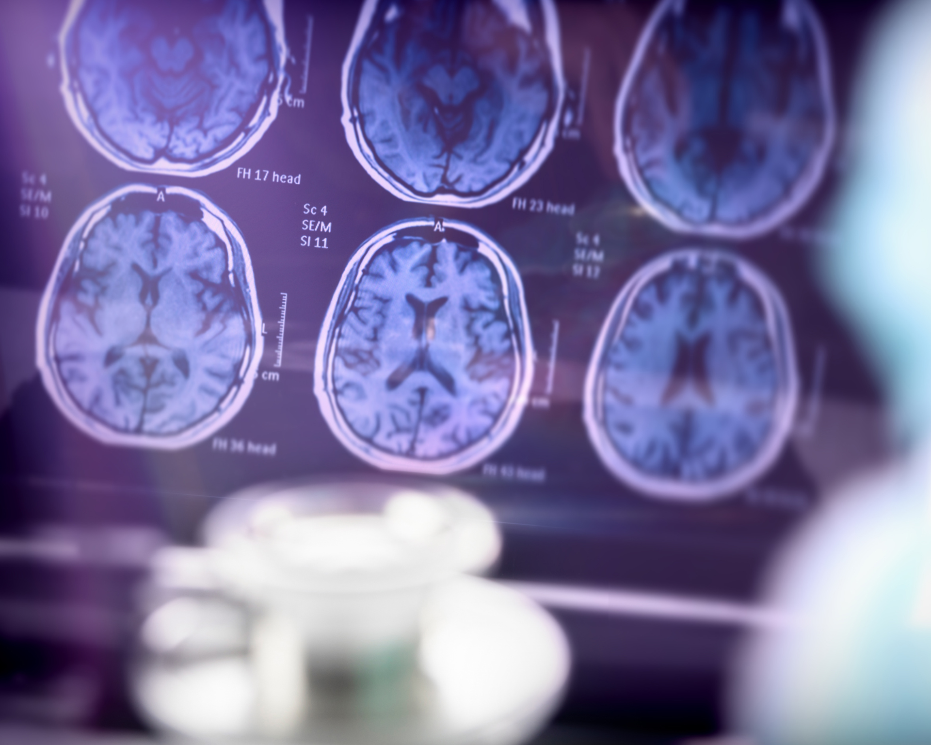 Brain scan. Brain health and stroke concept