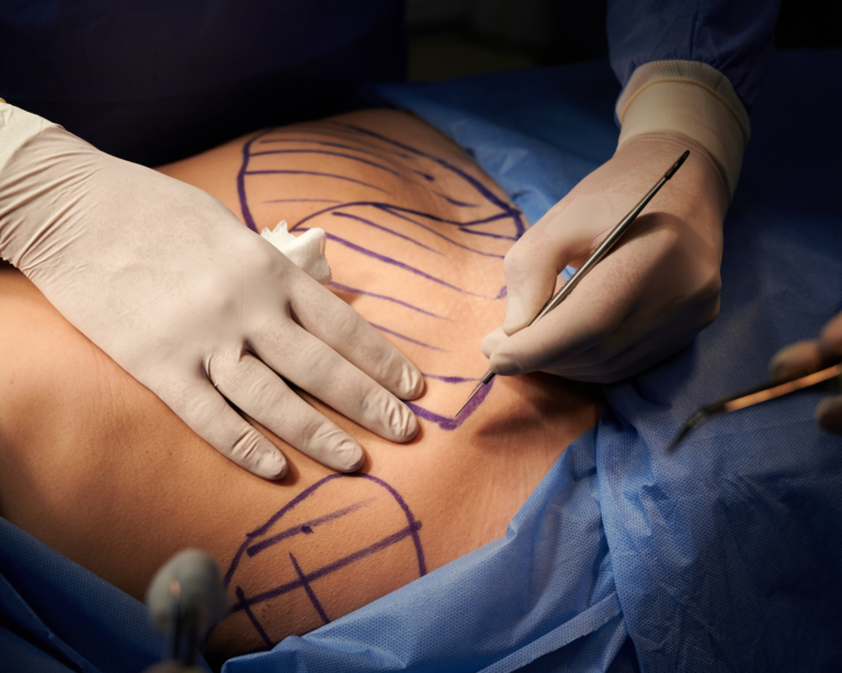 Doctor hands performing plastic surgery in the operating room.
