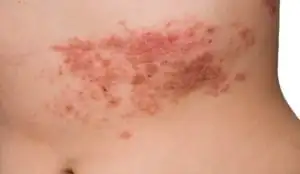 Torso with shingles blisters