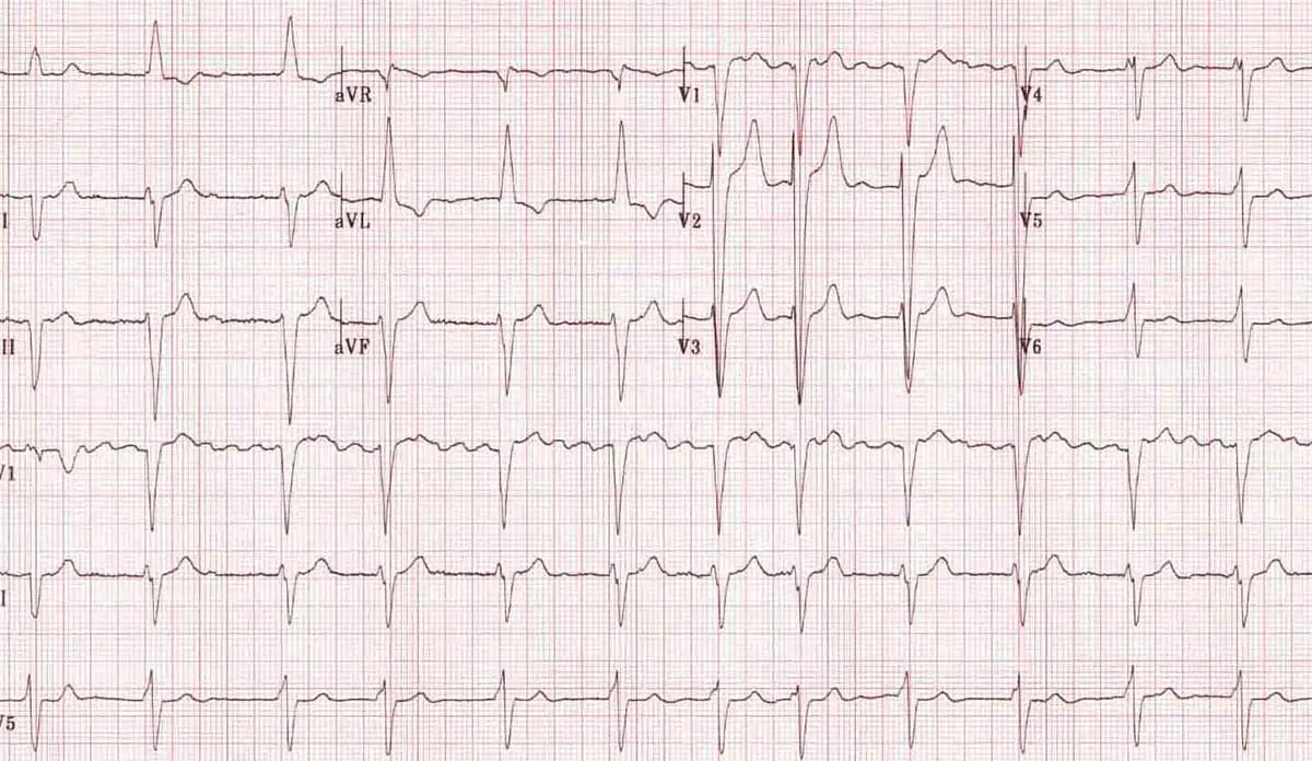 EKG showing atrial fibrillation