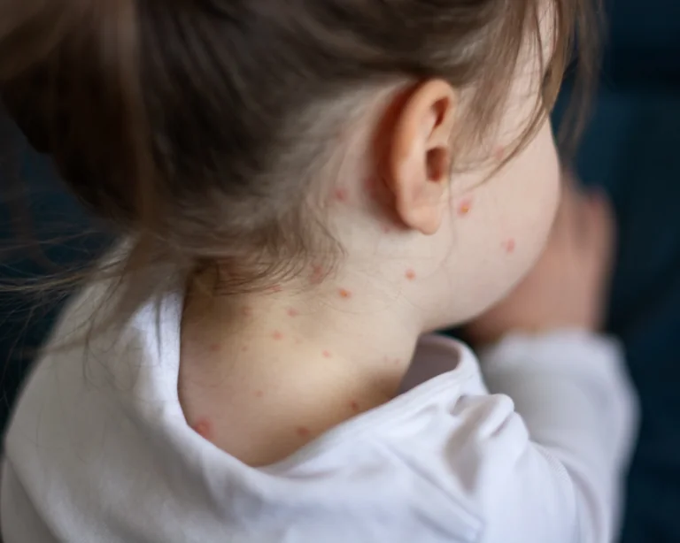 Close-up of a young girl with chickenpox measles on her body. Missed vaccination concept