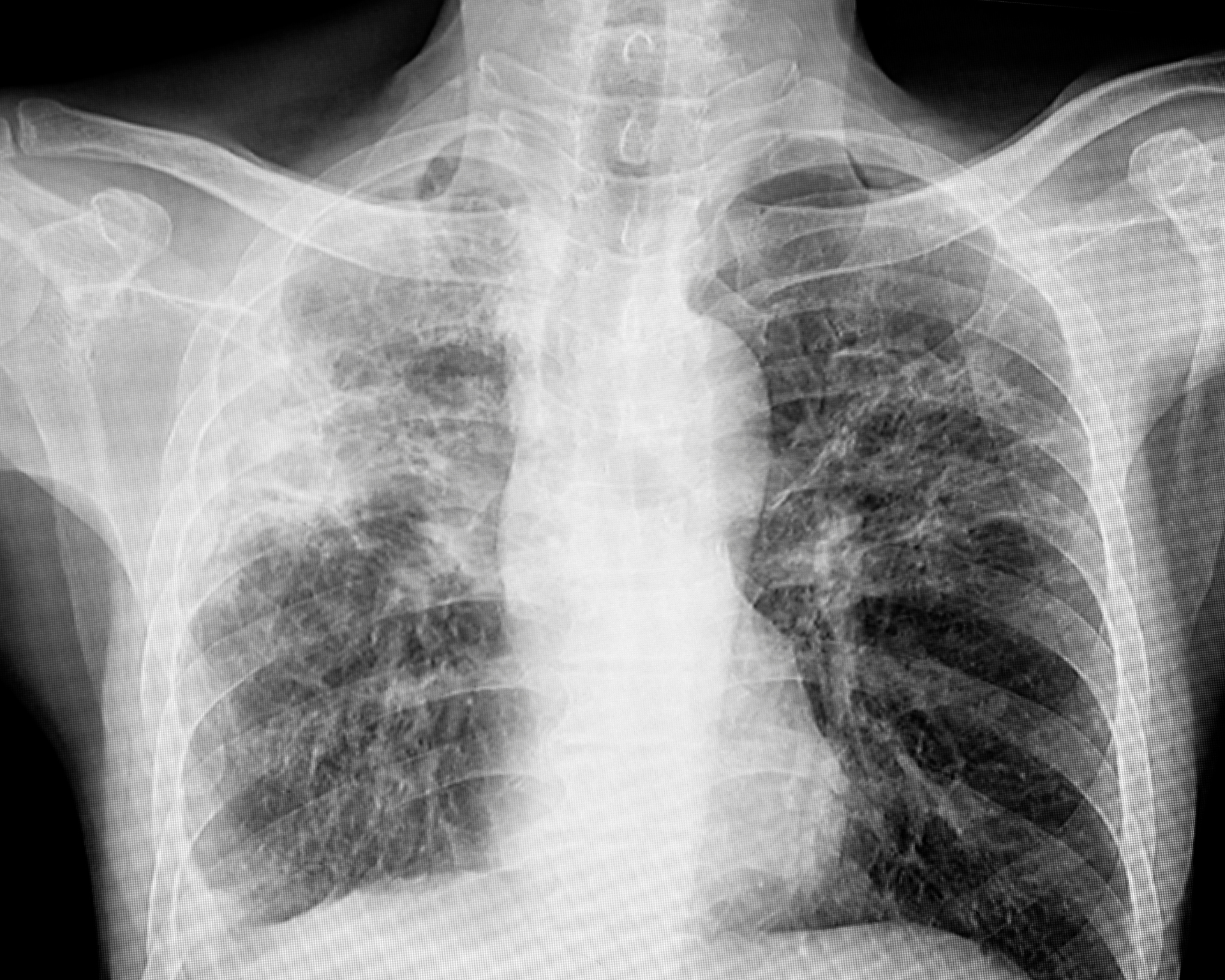 Chest X-ray of a patient with tuberculosis (TB) infection in lungs