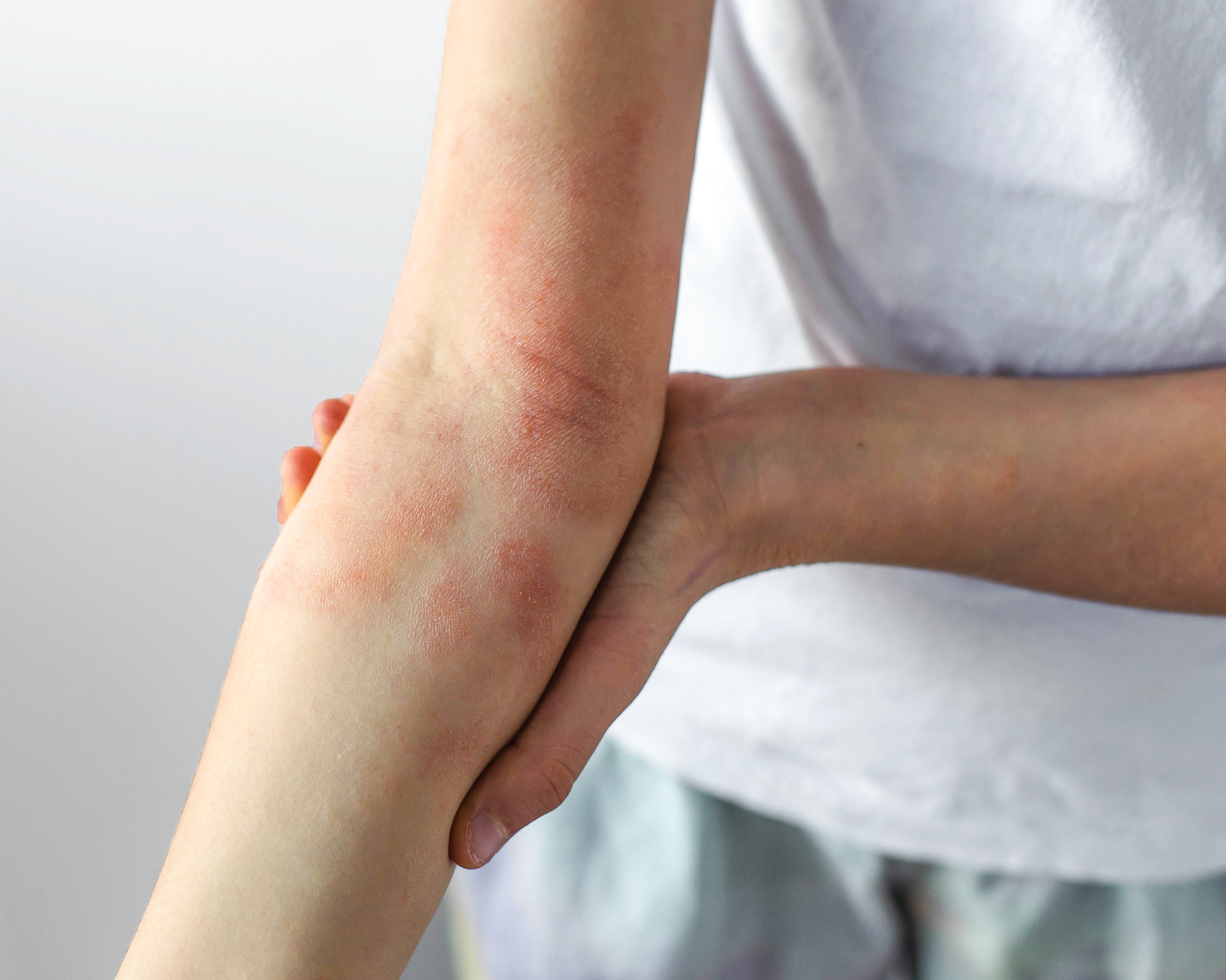 Closeup of a forearm with visible eczema irritation, red patches, sensitive, dry skin affected by atopic dermatitis, dermatology concept showing chronic allergy symptoms skin condition